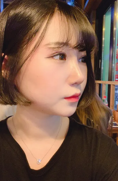 첫눈,눈매교정,앞트임,듀얼트임,콧대,코끝,매부리교정 너무 만족스럽습니다