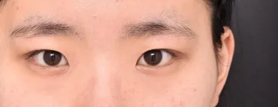 쌍수한지 지금 이제 어느덧 4개월차에요'ㅜ'!!!