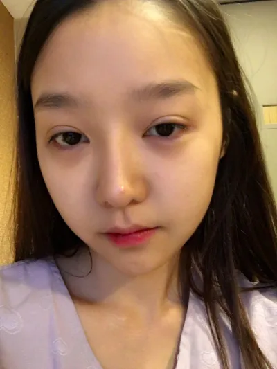 눈 재수술 받았구 요번엔 코 재수술 받았습니다.