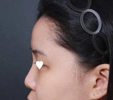 임영민 원장님께 코 수술을 받았어용ㅎㅎ