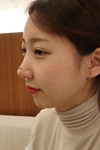 무턱끼가 있어서 턱끝수술 했습니다!!