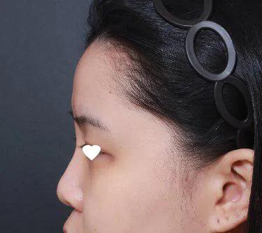 베리굿 성형외과에서 임영민 원장님께 코 수술을 받았어용ㅎㅎ