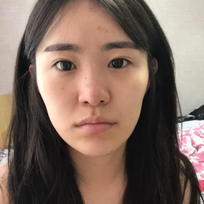 코 수술한지 4개월 정도 다 되어가요!