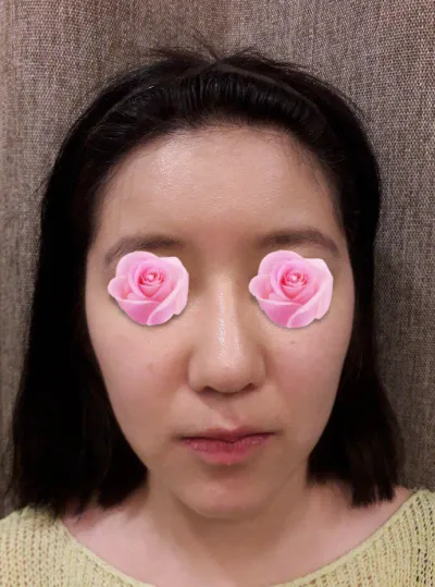 수술한지 2개월 되써욥 코재수술 윤곽 광대 긴곡선 턱끝 했습니당