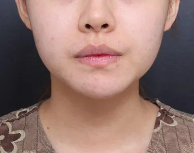 얼굴 지흡 후 한 달 정도 되었는데 얼굴 라인도 많이 잡혔구 너무 만족합니다.!