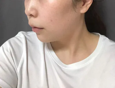 이중턱, 턱선 얼굴지방흡입한지 한달 후기 입니당~