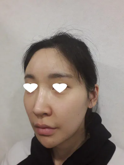 광대축소술 너무 자연스럽고 만족입니다^^