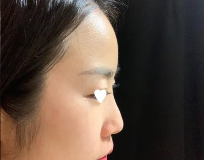 주변에서도 다들 라인 이쁘다고 난리입니다!ㅋㅋㅋ제가 원했던 코끝라인이예요ㅠㅠ 감사합니다.