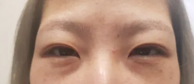 김준형원장님한태 절개로 쌍커풀재수술 받았어요~