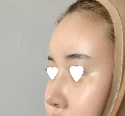 원장님은 임영민원장님께 코재수술 받았어요!!!