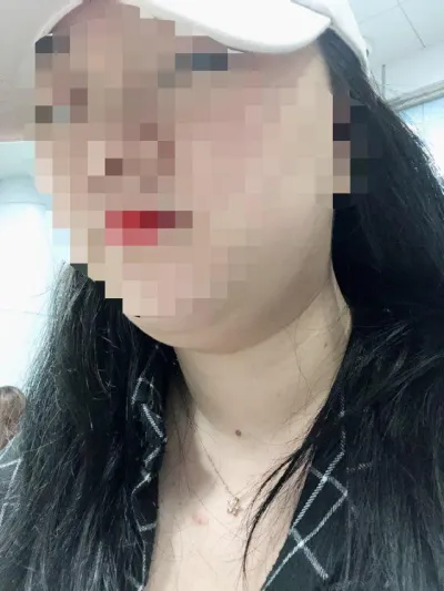 이중턱때문에 항상 고민하다가 얼굴 지방흡입을 받았습니다.