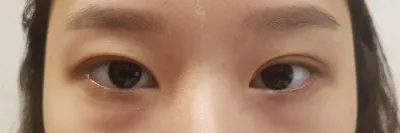 수술 거의 3개월쯤 후에 사진이에요~~ 후기남겨용!!~