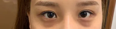 눈밑 지방재배치 했어요~ 후기 올립니당~