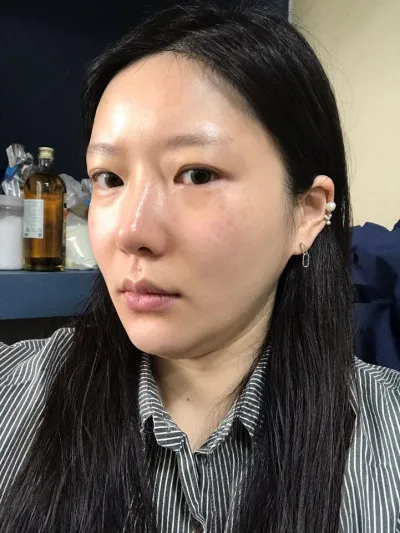 시술하고 3주정도 지난 후기에용~