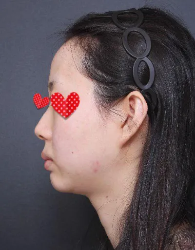 코, 지방이식 3주차인데 복코랑, 매부리, 이마꺼짐, 턱 으로 인해 받았던 스트레스 싹 사라졌어요