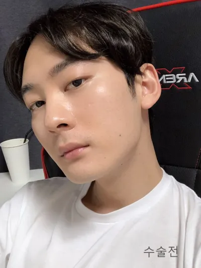 안녕하세요! 수술 하고 2달 경과후기 남겨요!!