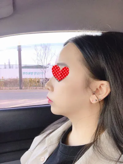 베리굿성형외과에서 4월9일 얼굴전체지방이식 받았어영~