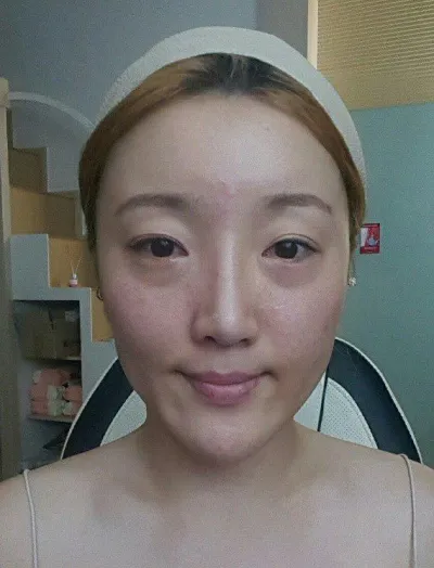 쌍커풀(절개)+뒷 밑트임+윤곽3종+눈밑지방재배치 3주차 후기 입니다.