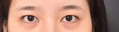 눈 재수술 4개월차 입니다. 지금은 너무 만족하면서 지내고 있어요.♥