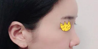 코재수술 3개월차에용^^