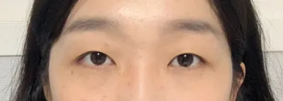 쌍수 후기 올려요!!ㅎㅎ