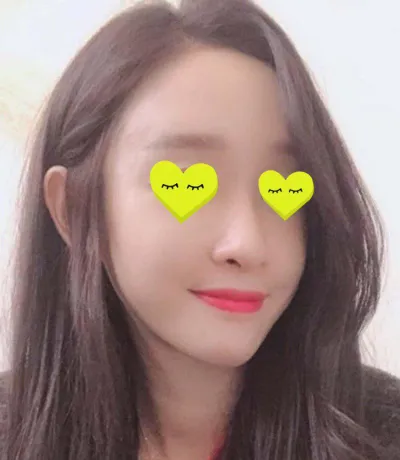 김준현원장님께 풀페이스 지방이식 받았어요!