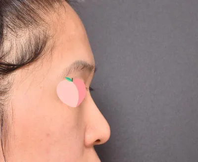 베리굿 성형외과 임영민 원장님께 코성형 받았어용