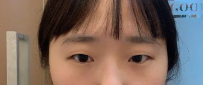 쌍꺼풀하길 잘한것같아요ㅠㅠ