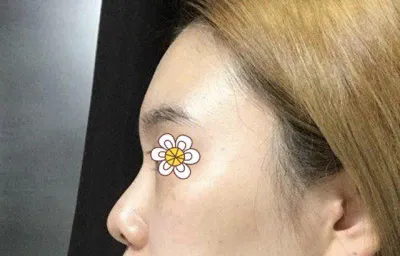 코재수술 너무 예뻐요!!!!