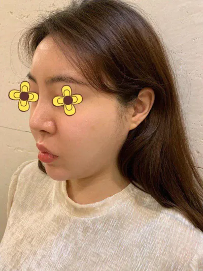 실리프팅하길잘했어요ㅠㅠ