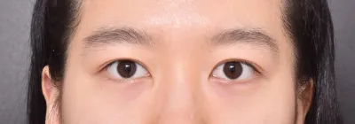 눈재수술 성공적이예여ㅠㅠ