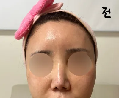 짧은코재수술후기