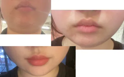 [**고객님] 인모드+뷰티핏주사 시술후기