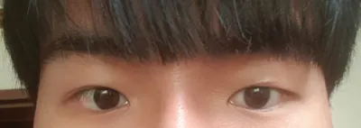 눈 재수술 수술후기