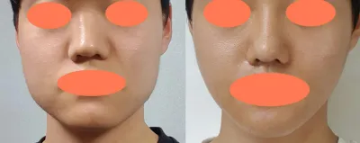 안면윤곽 수술후기