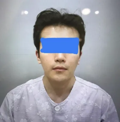 안면윤곽 수술후기