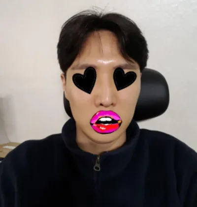 코 재수술 | 리프팅 수술후기