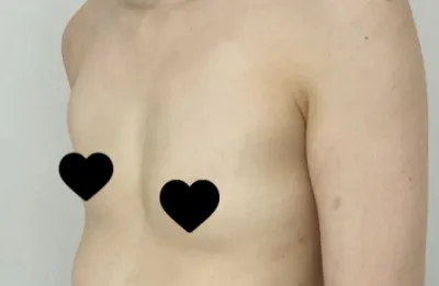 가슴수술 후기입니다.