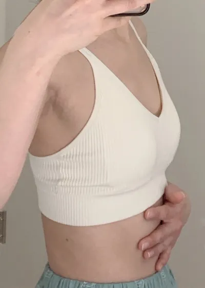 가슴성형 2달차 후기(모티바/ 355cc/ 밑절)