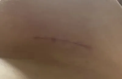 내 가슴모양에 맞게 솔직하게 상담해주셔서 예약했어요☺️