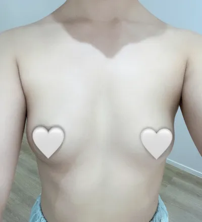 멘엑+부유방 제거) 1개월 대만족 후기