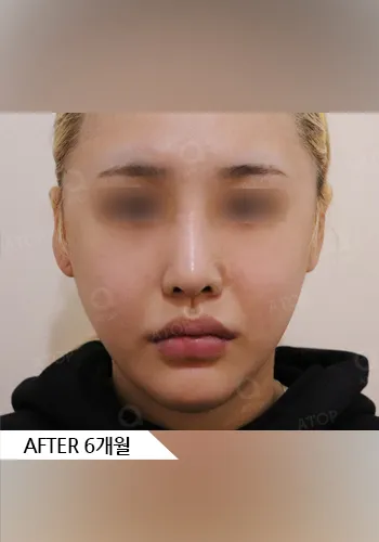 After