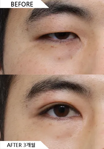 Before