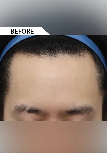 Before