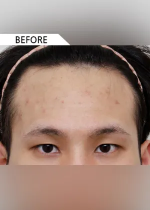 Before