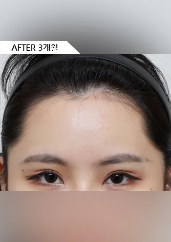After