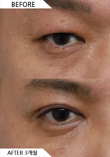 Before