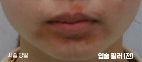 Before