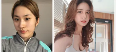 눈,코,안면윤곽,풀페이스 지방이식,입술필러