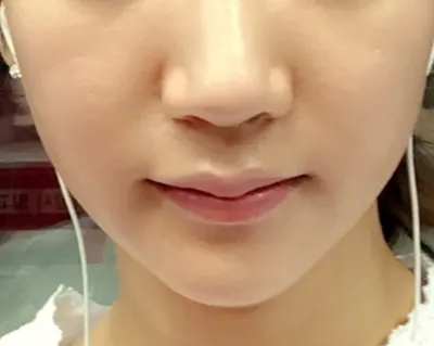 역시 써마지는 기술이네요